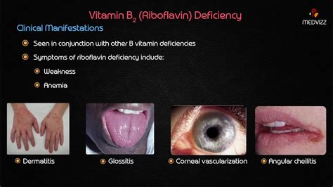 Vitamin B2 Riboflavin Deficiency Vitamin B2 Riboflavin Deficiency