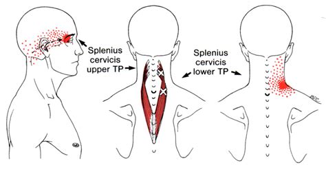 Splenius Capitis The Trigger Point And Referred Pain Guide