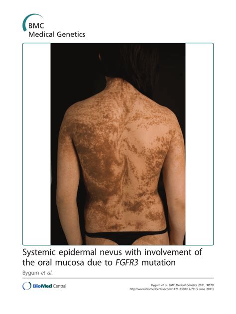 Epidermal Nevus Syndrome Symptoms Captions Tempo