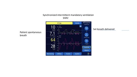 Demystifying Ventilator Modes Its Not That Complicated Ems Airway