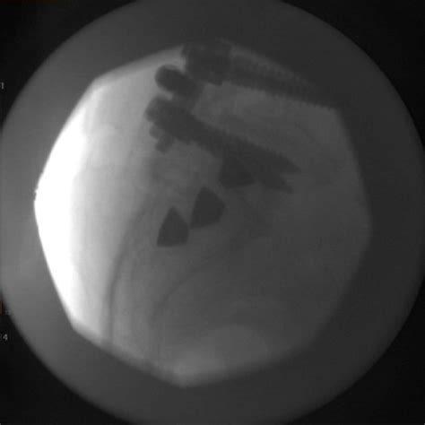 Lateral A Image Of Linq Implant Seated Within The Sacroiliac Joint Download Scientific