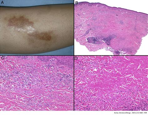 Granulomas In Dermatopathology Principal Diagnoses Part 1 Actas