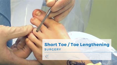Toe Straightening Short Toe Correction And Toe Lengthening Surgery