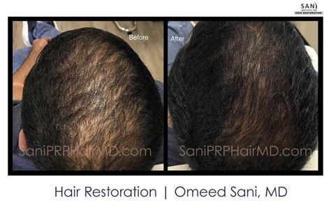 Non Surgical Hair Restoration Gallery Photos Of Actual Patients Sani Hair Institute