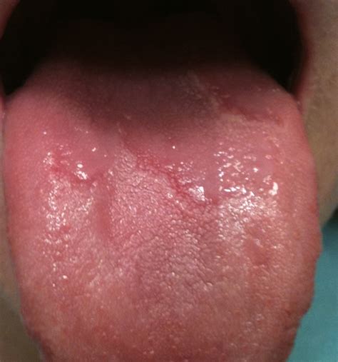 Blisters In Mouth And Tongue First Butt Sex 0 Hot Sex Picture