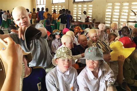 Albinos Plight Sends Canadian Into Action