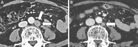 A Ct Showed A Swollen Para Aortic Lymph Node Of Size 12 Mm In Diameter