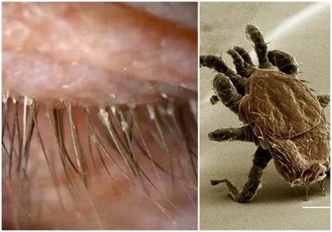 25 Images Eyelash Mite Removal Demodectic Mange