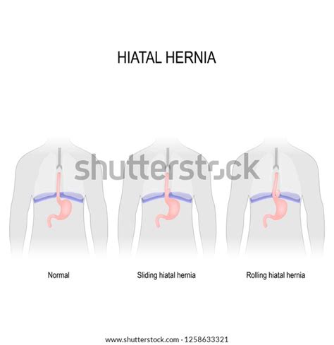 Hiatal Hernia Vector Diagram Different Types 스톡 벡터로열티 프리 1258633321