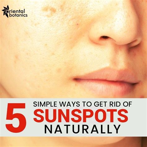 5 Simple Ways To Get Rid Of Sunspots Naturally Sunspots Sun Spots On