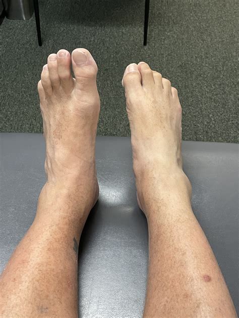 Foot Drag Foot Drop Dragging Leg While Walking Core Therapy And Pilates