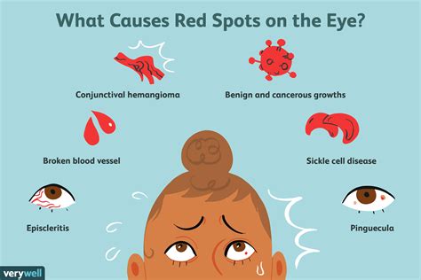 Red Spot On Eye Causes And When To Seek Help