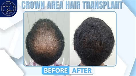 Crown Hair Transplant Case Study And Result Best Hair Transplant