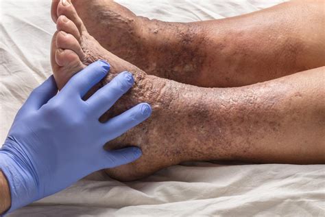 Types Of Eczema On Feet
