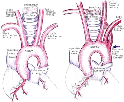 Figure 4 From Aberrant Right Subclavian Artery Encountered During