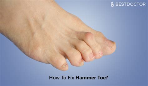 A family history of mallet toe, hammertoes, etc. How To Fix Hammer Toe Without Surgery|With Tape|Exercises