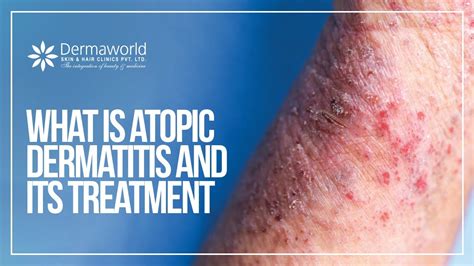 What Is Atopic Dermatitis And Its Treatment Dr Rohit Batra