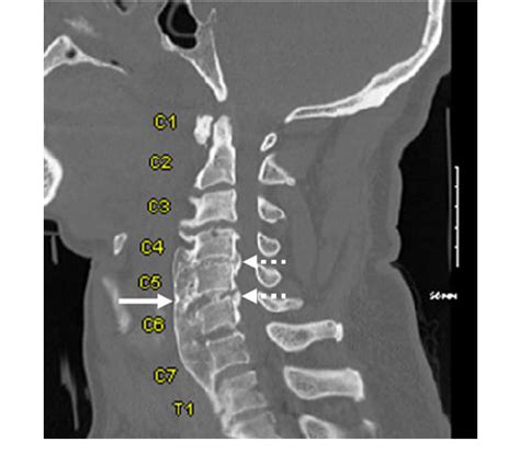 Cervical Spine Anatomy Ct Scan