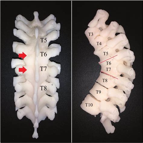 Three Dimensional Printed Spine Model Showing The Fused T6 And T7