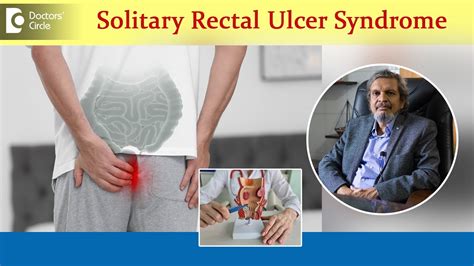Ulcer On Bottom Solitary Rectal Ulcer Syndrome Causes And Treatment Dr