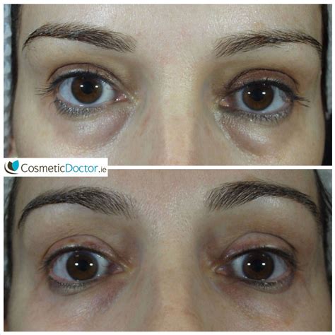 Before And 1 Month After Tear Trough Treatment With Fillers Cosmetic