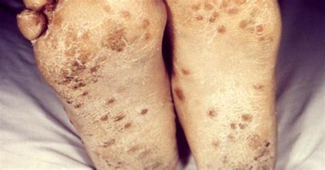 Most melanomas are either brown or black. Foot Rash | FindATopDoc