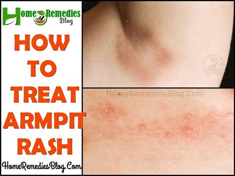 15 Home Remedies For Itchy Armpit Rash Home Remedies Blog
