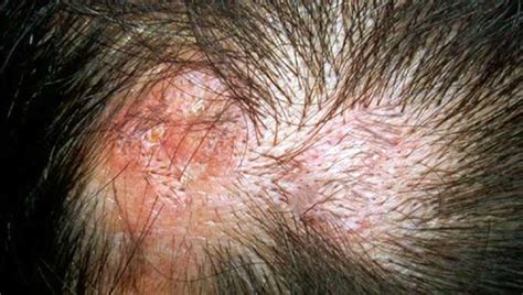 Discover More Than 75 Hair Scalp Infection Super Hot Ineteachers