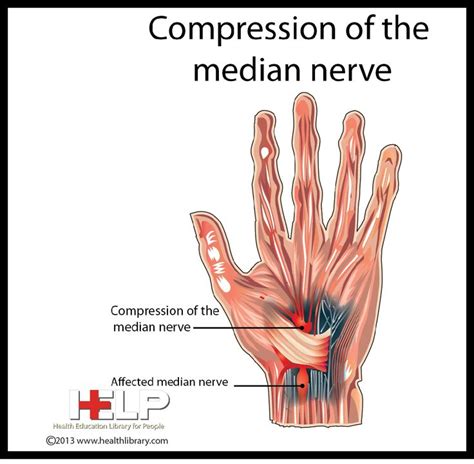 Compression Of Median Nerve