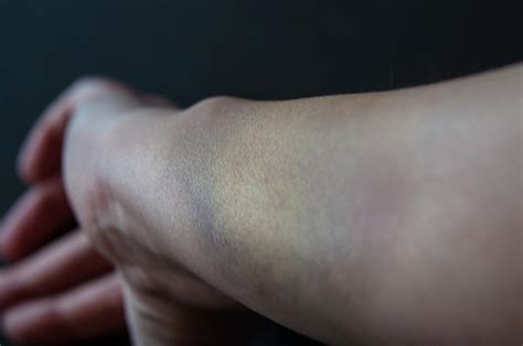 Bruised Arm Photograph By Frank Gaertner