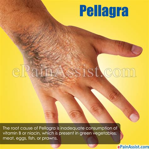 Pellagra Treatment Causes Symptoms Risk Factors Diagnosis