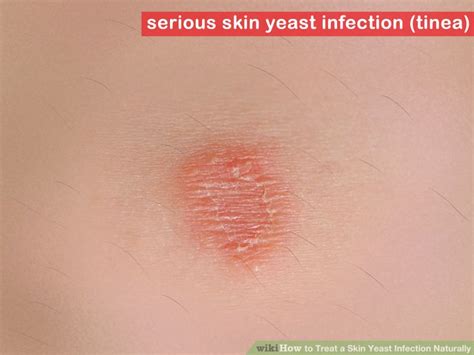 Skin Yeast Infections Pictures Photos