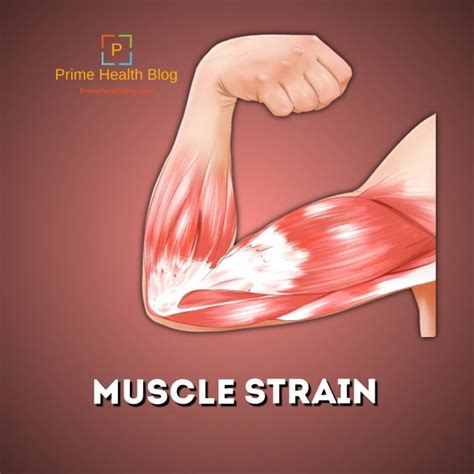 Why Muscle Strain Is Very Common Now A Days Prime Health Blog