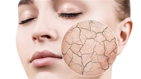 5 Signs You Have Dehydrated Skin How To Fix It
