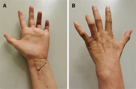 Ulnar Nerve Injury Associated With Displaced Distal R