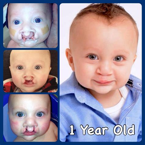 Bilateral Cleft Lip And Palate With Nam Cleft Lip And Palate Cleft