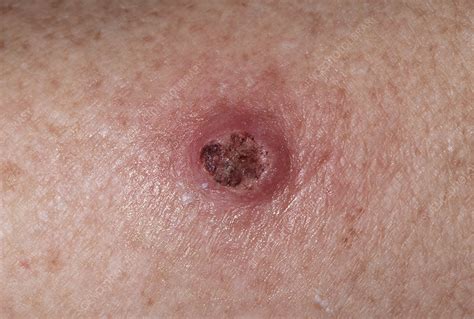 Keratoacanthoma Squamous Cell Carcinoma Of The