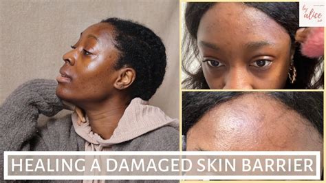 I Damaged My Skin Barrier Here S How I Fixed It Repairing My Compromised Skin Barrier