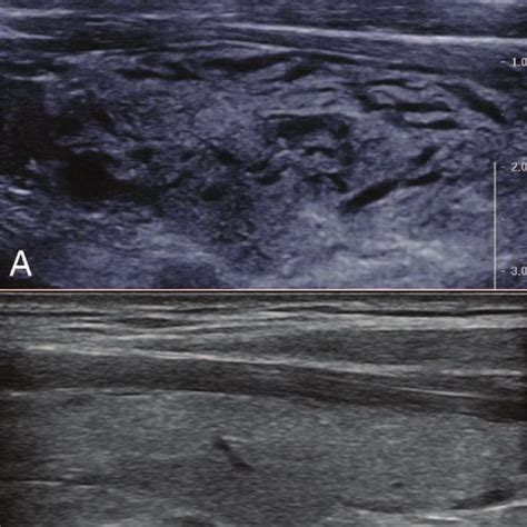 Longitudinal Ultrasound Of The Left Thyroid Lobe A Almost 30 Minutes