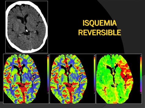 Para que o corpo humano funcione na perfeição é necessário que a circulação. PPT - TC PERFUSIÓN CEREBRAL PowerPoint Presentation, free ...