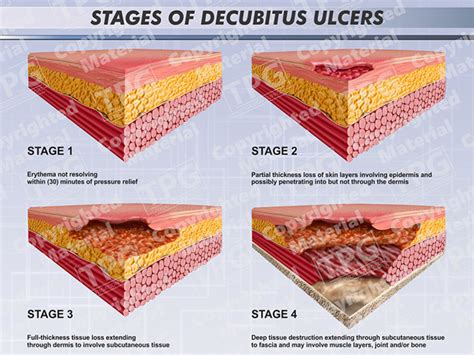 Stages Decubitus Ulcers Presentation Group Medical Illustrations