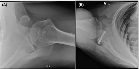 Alternative Positioning Method For The Superiorinferior Axial Shoulder