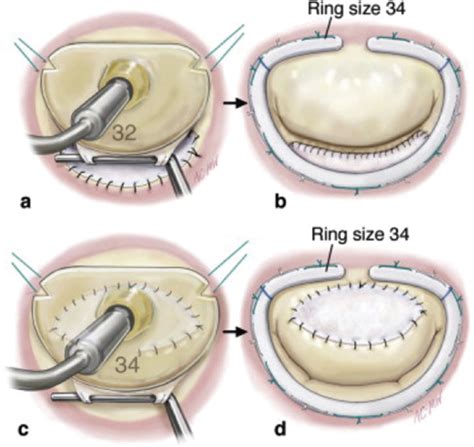 A Systematic Review Of Mitral Valve Repair With Autologous Pericardial