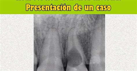 Pdf Reabsorción Dentaria Interna Presentación De Un Caso