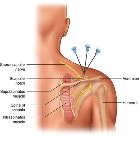 Suprascapular Nerve Blocks And Neurolysis Springerlink