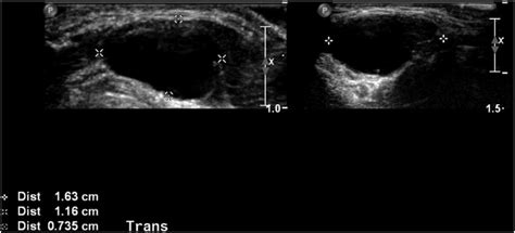 An Ultrasound Scan Of The Anterior Midline Neck Mass A Well Defined 16