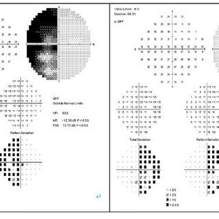 Pre Operative Visual Field Test Download Scientific Diagram