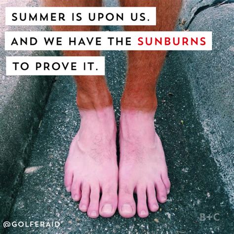 Get Ready To Lol And Feel Immense Pain For These Summer Sunburn Fails
