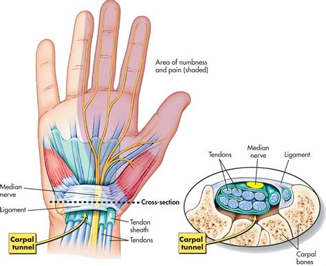 Carpal Tunnel Syndrome | Osteohealth