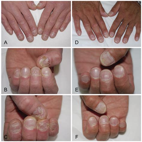 Psoriasis Of The Nails Images Tutorial Pics
